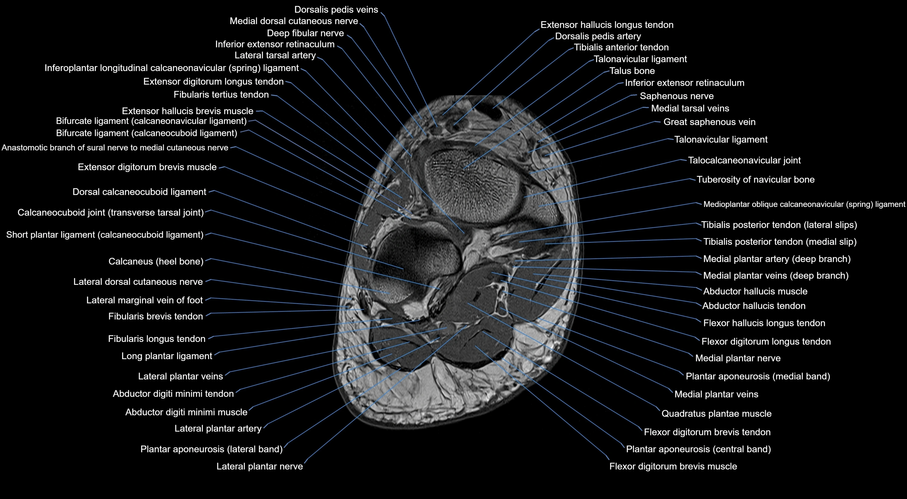 MRI mid foot coronal ligaments cross sectional anatomy 3T  radiology  image-img-00001-00035.webp